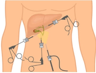 Cirugía de Vesícula